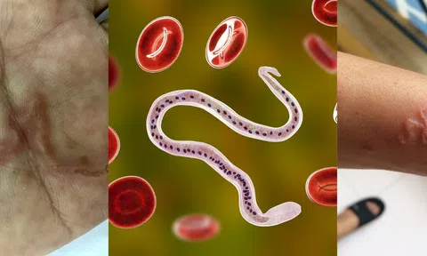 Nhiễm sán vì thói quen nhiều người mắc phải