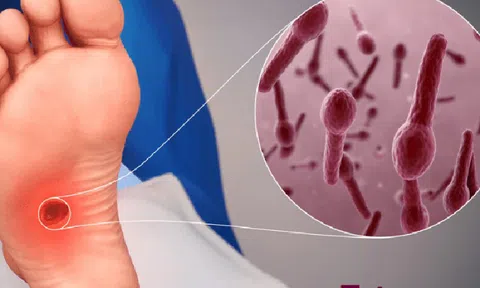 Nguy kịch vì chủ quan với vết xước nhỏ