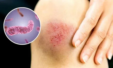 Mùa mưa, cẩn trọng bệnh Whitmore