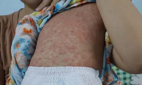 TP.HCM: Công bố dịch sởi, sẵn sàng ứng phó