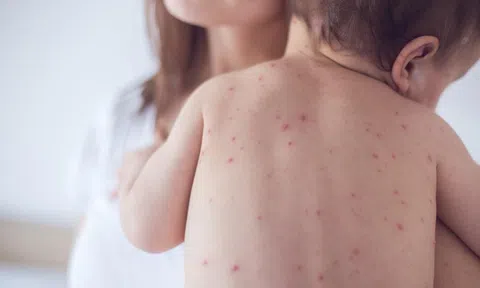 Phòng bệnh sởi cho trẻ trong mùa dịch