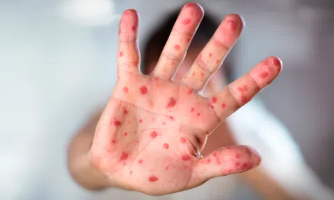 Sởi có thể khiến trẻ giảm miễn dịch lâu dài